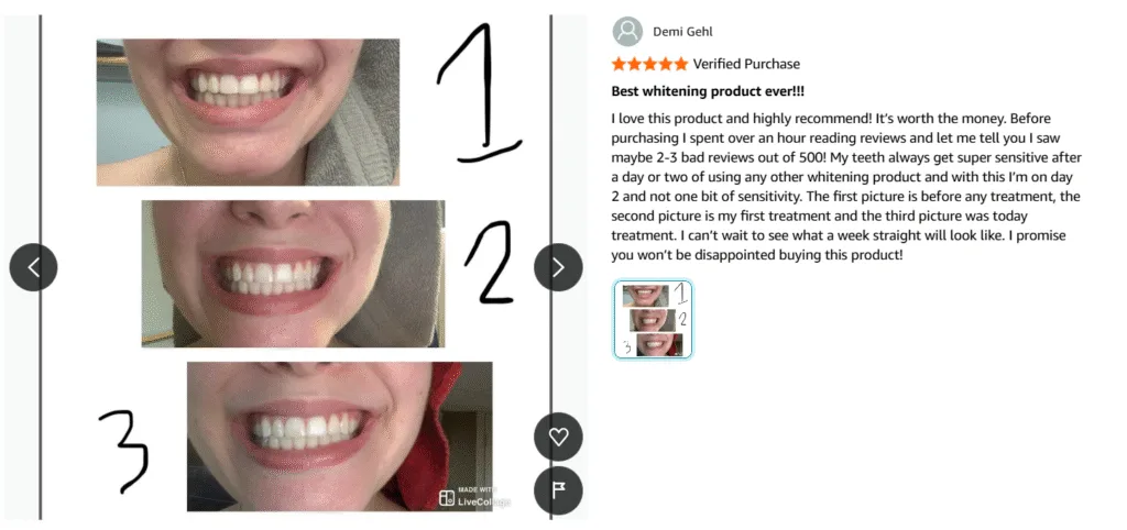 LED teeth whitening kits