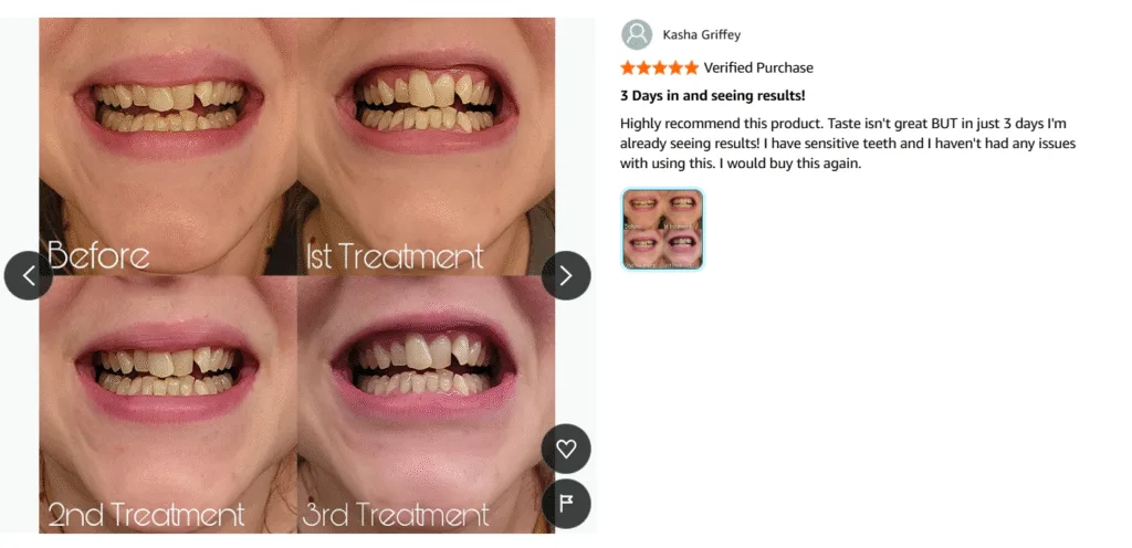 LED teeth whitening kits